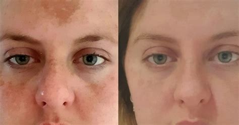 Dramatic Before And After Photos Show Difference After Using Retinol