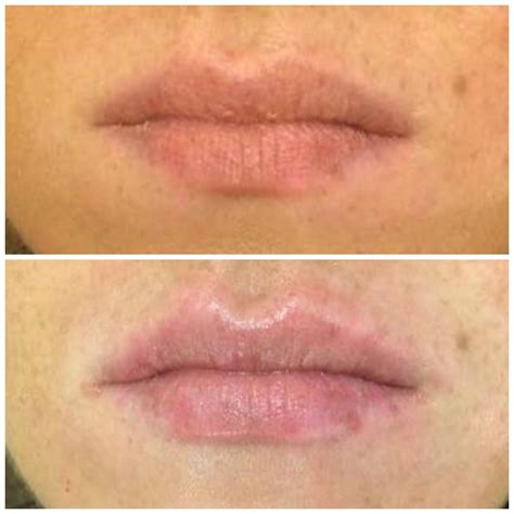 My Lip Fillers Gone Wrong Laura Gemma Meachem