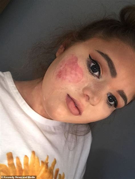 Teens Parents Accused Of Burning Her Due To Rare Birthmarks Fitness