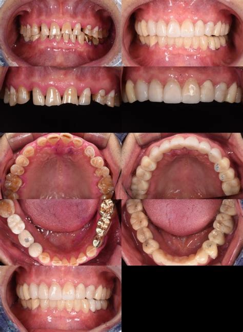 Composite Resin Rehabilitation Of Worn Down Dentition Myzerodonto