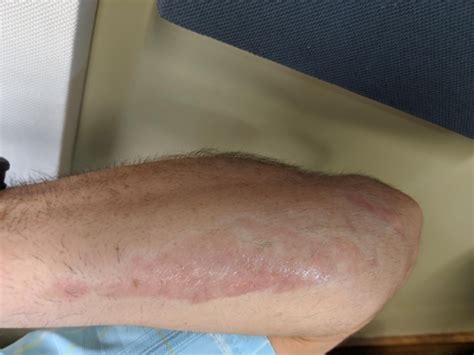Road rash can lead to infection, scarring, and substantial disability. The BEST Scar Removal Creams [Proven to work and ...