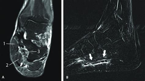 MRI of the left foot. Coronal reformatted T2-WI FS (A) showing subtle