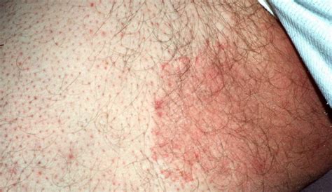 Ringworm Not Caused By Worms