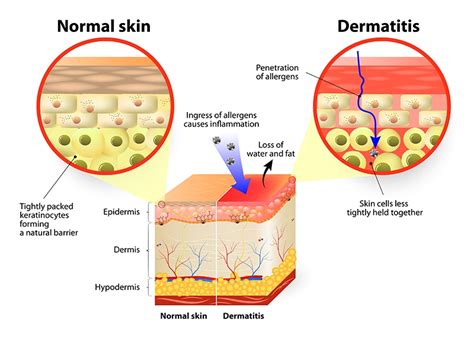 Stages Of Eczema Labelled Ph