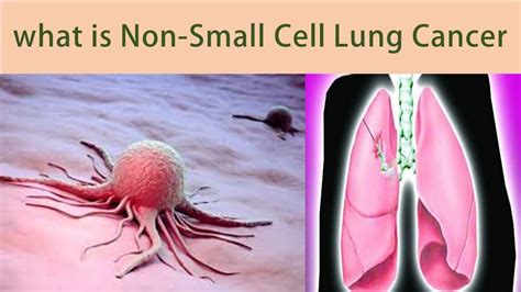what are the signs and symptoms of small cell lung cancer types of lung cancer non small