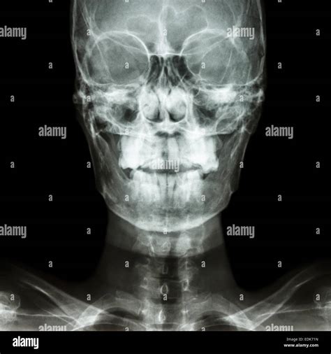 Film X Ray Skull Ap Show Normal Humans Skull And Blank Area At Right