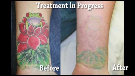 Remove Tattoo Before After Safe And Effective Tattoo Removal
