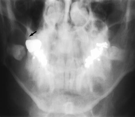 Cysts And Cystic Lesions Of The Mandible Clinical And Radiologic