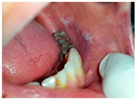 It may also occur on the mucosa of the larynx or vagina. Dentistry Journal | Free Full-Text | Oral White Lesions ...