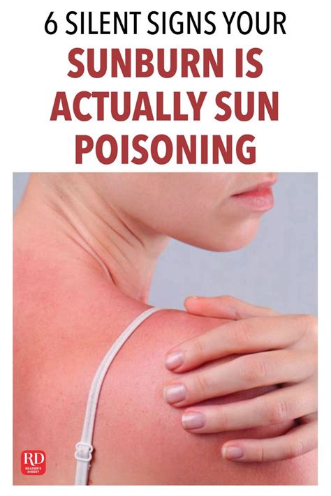 6 Silent Signs Your Sunburn Is Actually Sun Poisoning Severe Sunburn