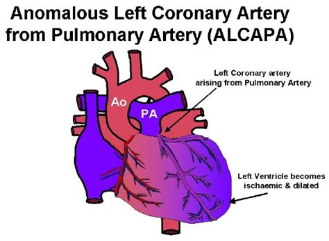 Neither patient received surgical treatment although both have lived to middle age with minimal cardiovascular. Michaela's Broken Heart Our ALCAPA Warrior: What is ALCAPA?