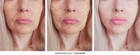 Woman Face Wrinkles After Treatment Stock Photo Edit Now 1358000276