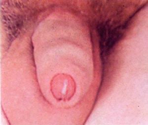 Infecciones De Transmici N Sexual Venereas Cervicitis
