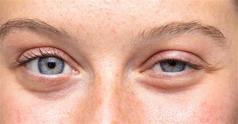 Droopy Eyelids Ptosis Ophthalmic Plastic Surgeon In Mumbai Dr Sneha J Shah