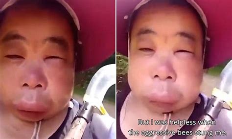 Chinese Woman Left With A Huge Swollen Face After Being Stung By Bees