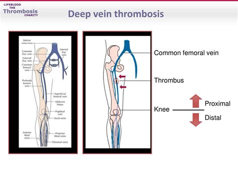 Ppt Venous Thromboembolism Treatment And Secondary Prevention Powerpoint Presentation Id