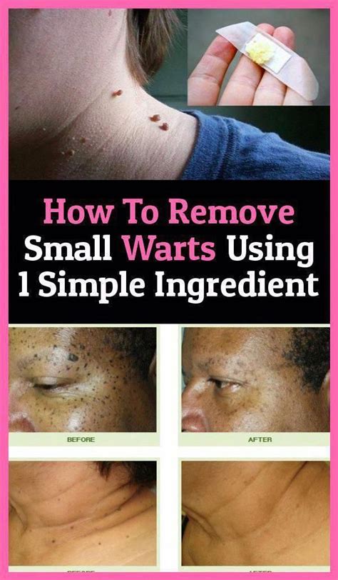 Pin On Skin Warts Removal Home Remedy