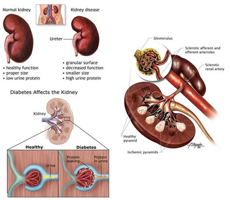 It is also called diabetic nephropathy. Diabetic nephropathy is kidney disease or damage that can occur in people with diabetes ...