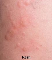 You'll probably notice obvious symptoms on your skin first—and they can be very painful and uncomfortable. Rash | eCellulitis