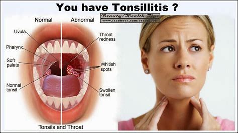 Ayurvedic Herbs Treatment And Consultation Tonsillitis Treatment By