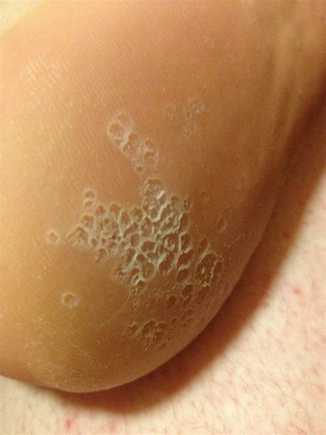 Small Circles Of Dry Skin Appearing On Sole Of Foot Rhealth