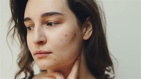 The Worst Types Of Acne And How To Cure Them Shujo Aesthetics