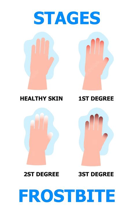 Premium Vector Frostbite Stages Infographic Vector Hypothermia In