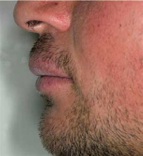 Swelling Involving The Entire Upper Lip Download Scientific Diagram