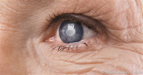Grauer Star Symptome Ursachen Behandlung