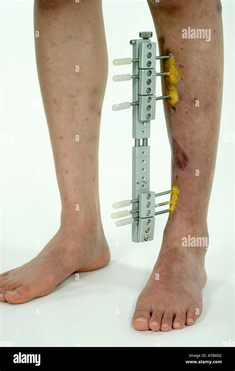 Fractured Tibia With External Fixator Stock Photo Alamy