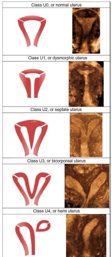 Figure Classification Of Main Uterine Anomalies Diagnostic Medical