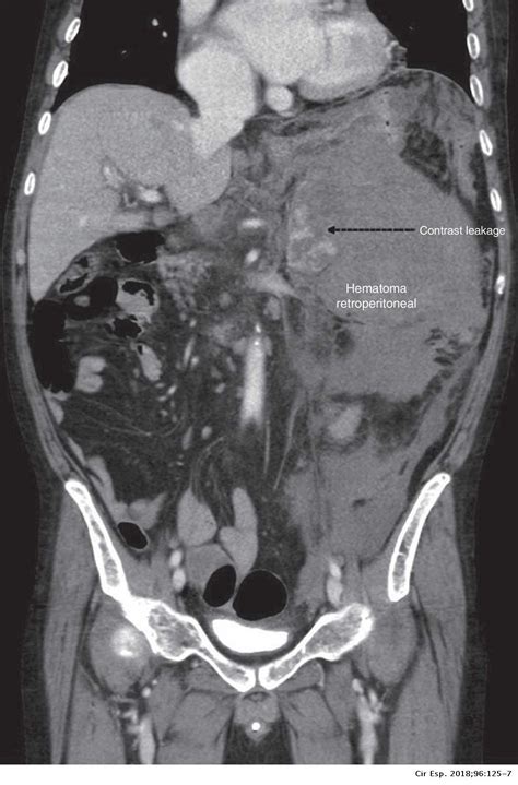 Retroperitoneal Bleed Ct Scan With Or Without Contrast Ct Scan Machine