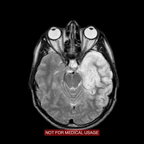 Ct scan of the head. Herpetic encephalitis | Image | Radiopaedia.org