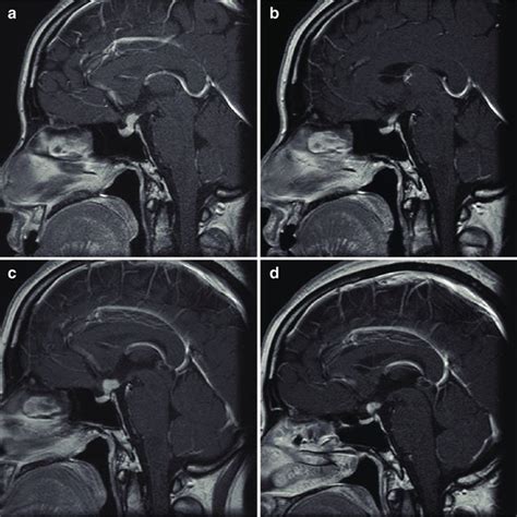 Mr T1 Weighted Imaging With Gadolinium Enhancement A A Well Enhanced