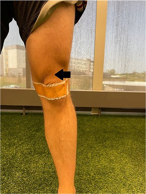 Medial Mcconnell Taping With Tape Applied Pulling From Lateral To
