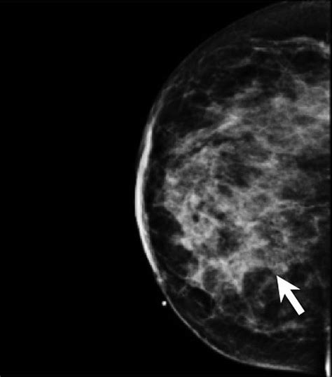 Idiopathic Granulomatous Mastitis An Inflammatory Breast Condition