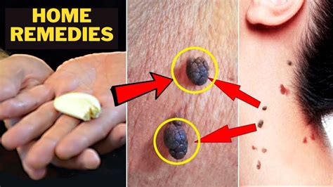 home remedies to get rid of skin tags naturally youtube