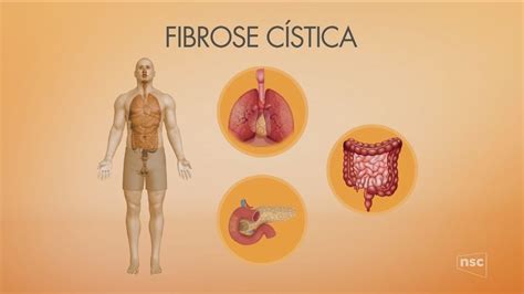 A collection of disease information resources and questions answered by our genetic and rare diseases information specialists for cystic fibrosis. Dois remédios para fibrose cística chegam ao Brasil. O que ...