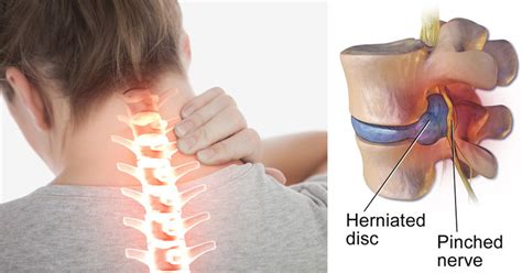 What are the treatments for a slipped disc? 7 Easy-To-Miss Signs of a Slipped Disc and How to Fix It ...