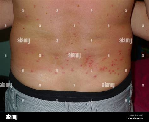 Sandfly Bites On A Males Back Common In Belize Thailand And Stock Photo Alamy