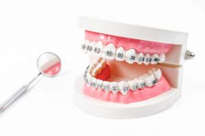 The goal is to improve aesthetics such as the shape, color, position, and alignment of your teeth. Does Insurance Cover Orthodontics?