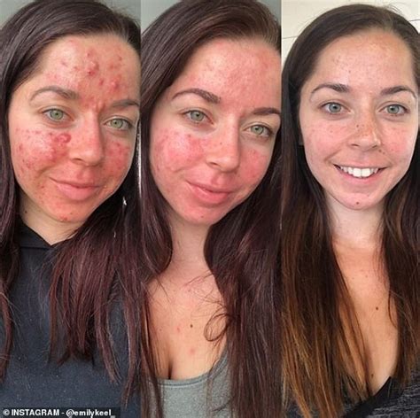 Personal Trainer Who Had The Worst Acne Ever Seen Shares Her Striking Before And After