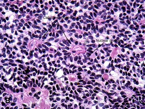 Granulosa Cell Tumor Gct American Urological Association