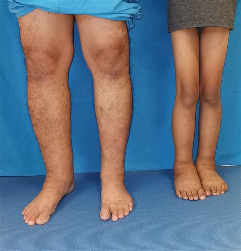 Primary Lymphedema In A Pediatric Patient Consultant360