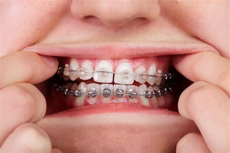 Braces Myths Busted Valderrama Orthodontics