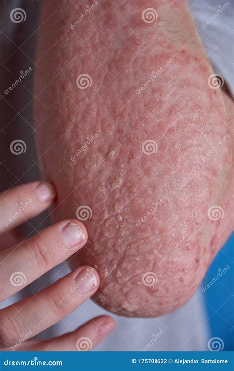 Forearm View With Psoriasis Stock Photo Image Of Eczema Rash 175708632