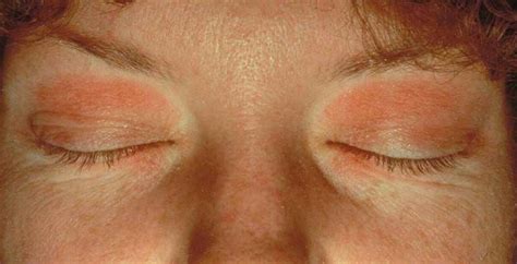 Eyelid Dermatitis Xeroderma Of The Eyelids Eczema Of The Eyelids