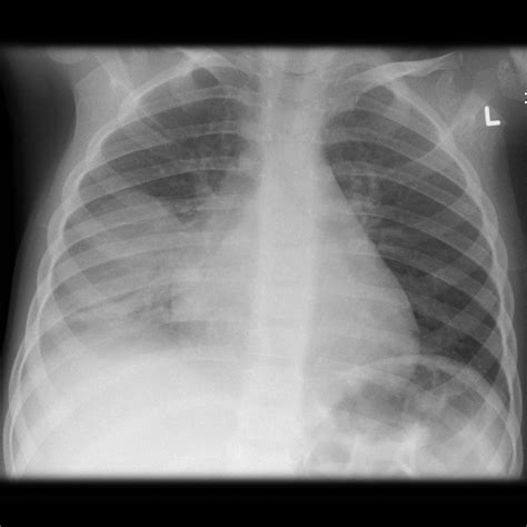 In this work, the authors have reported three schemes of classifications: Round pneumonia | Image | Radiopaedia.org