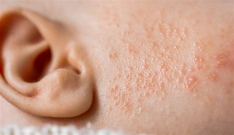 Skin Rashes On Babies What You Should Know