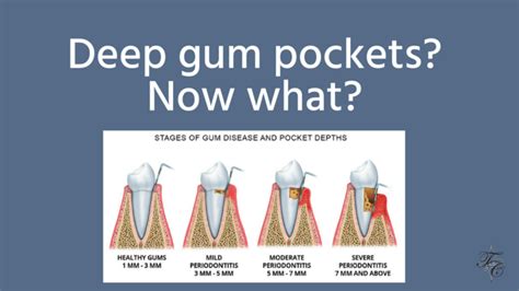 Deep Gum Pockets Tim Chauvin Dental Lafayette La Dr Chauvin